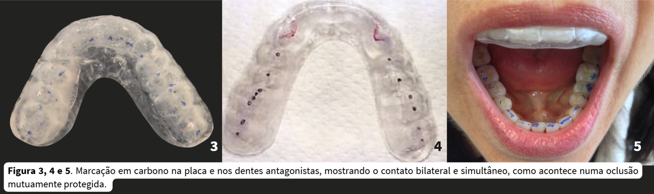 Três vistas clínicas mostram marcas de contato em uma placa oclusal e nos dentes