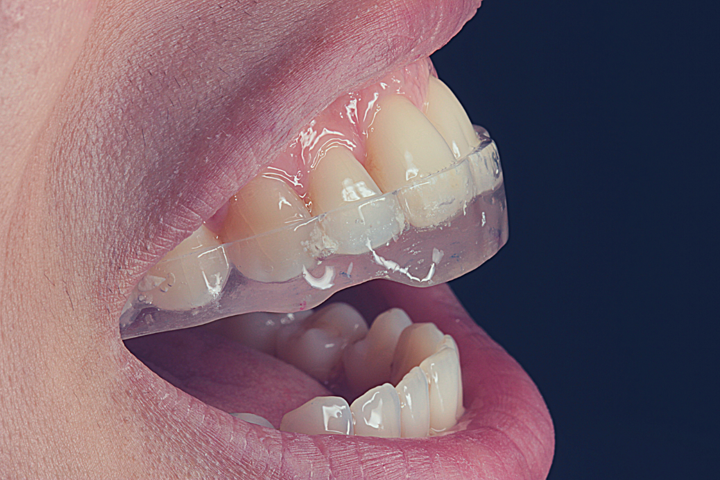 Placa oclusal transparente posicionada sobre os dentes superiores